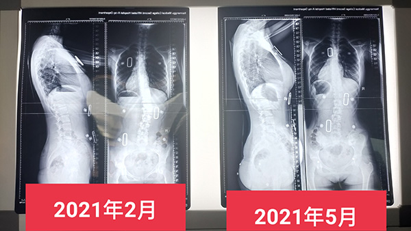 穿戴脊柱側(cè)彎支具的十大常見(jiàn)問(wèn)題